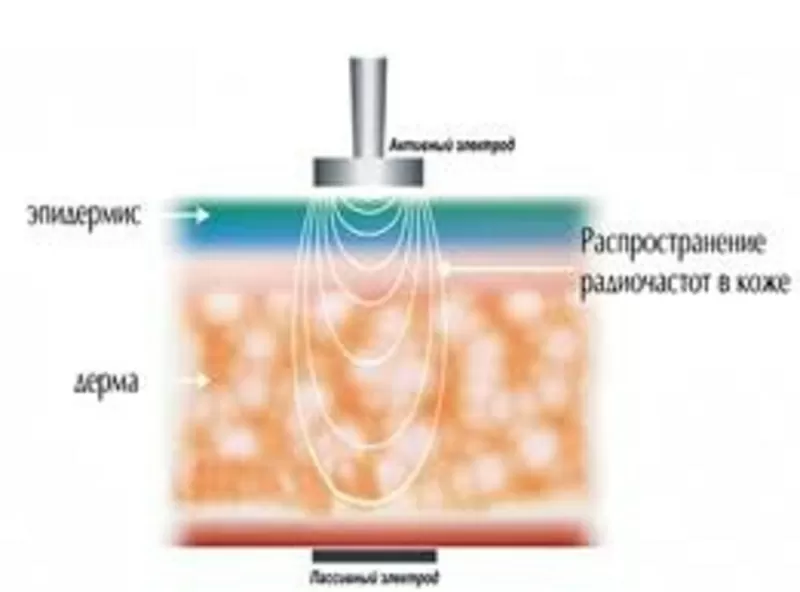 Радиочастотный лифтинг кожи (омоложение) 4